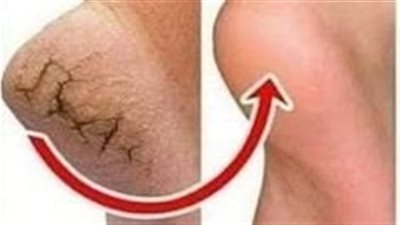 شكرا لطبيبة الجلدية التي اعطتني الوصفة الطبيعية الرائعه لعلاج تشققات وخشونه القدمين