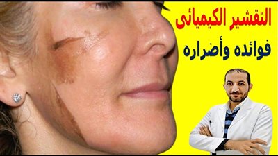كل ما تريد معرفتة عن التقشير الكيميائي للبشره