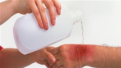 ما هو علاج الح.روق ؟