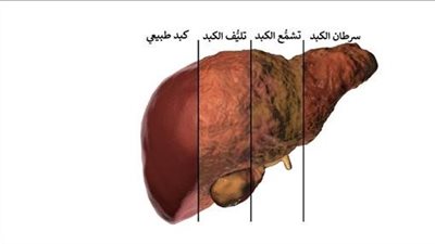 ما هو علاج تليف الكبد ؟