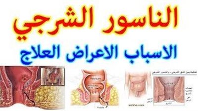 ما هو علاج الناسور ؟