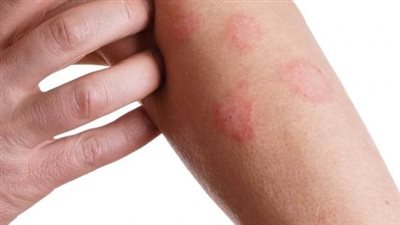طرق علاج مرض بهجت بالأعشاب