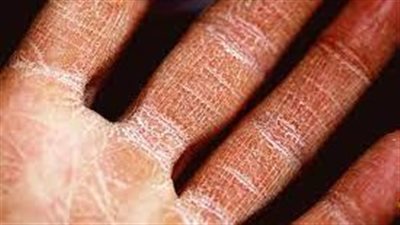 جفاف الجلد: الأسباب والعلاجات