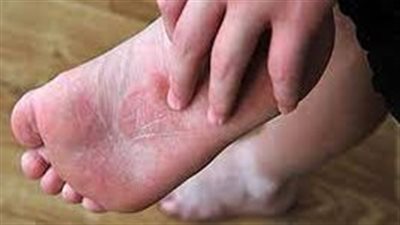 حكة باطن القدم: الأسباب والعلاج