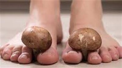 فطريات القدم: أسباب وأعراض وعلاج