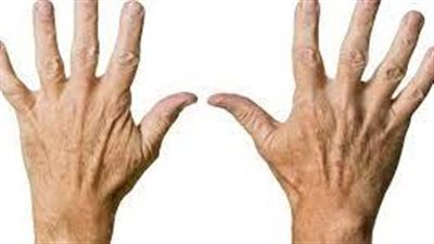 أسباب تجعد اليدين: ما هي؟