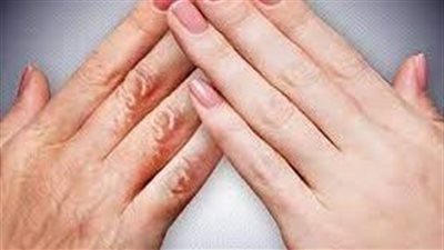 إزالة تجاعيد اليدين: طرق منزلية وطبية