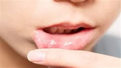 ما هي أسباب تقرحات الفم؟