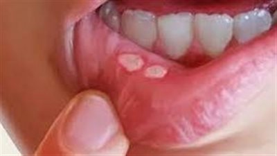 ما هي أعراض تقرحات الفم؟