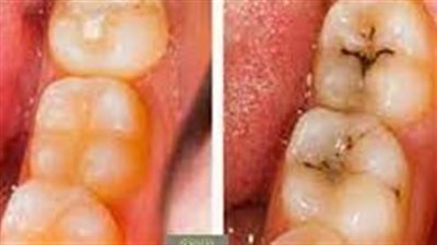 علاج تسوس الأسنان: وداعاً للآلام واستعادة صحة الفم