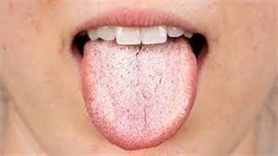ما هي أنواع فطريات اللسان؟