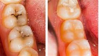 القضاء على التسوس: وداعاً للثقوب في أسنانك!
