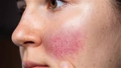 5 أسباب شائعة ل احمرار الوجه وسخونته