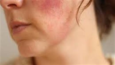  سبب ظهور بقع حمراء في الوجه: وداعاً للبشرة المتهيجة