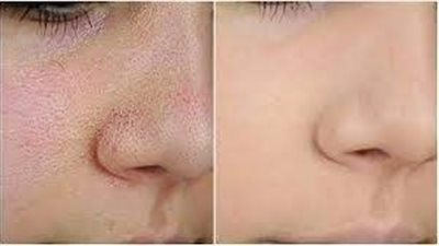 كيف أخفي مسامات وجهي؟ وداعاً للبشرة الخشنة!