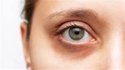  علاج الهالات السوداء تحت العين للحصول على نظرة مشرقة