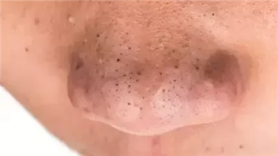 تعرف على وصفات مذهلة للتخلص من الحبوب الموجودة على والأنف
