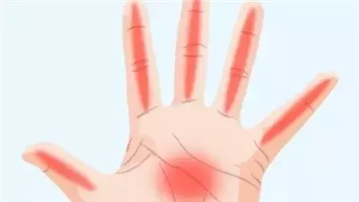 أعراض إذا ظهرت على الأيدي فإنها تشير لوجود مشاكل صحية