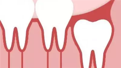 متى تكون إزالة ضرس العقل ضرورية