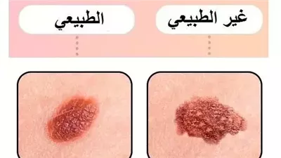أعراض إذا ظهرت على الشامة فإنها تشير إلى مشكلة صحيّة