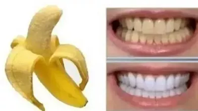 كيفية تبييض الأسنان وتلميعها 