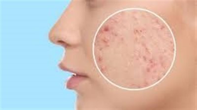 علاج ندبات حب الشباب طبيعياً