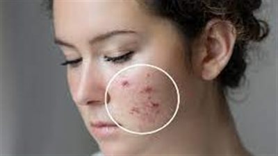 وداعاً لندبات الحبوب: رحلة نحو بشړة صافية وجميلة