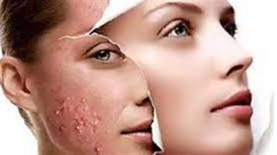 3. بشړة صافية خالية من آثار حب الشباب: حلم أصبح حقيقة