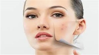  حلول طبيعية لإزالة حب الشباب وآثاره في أسبوع.