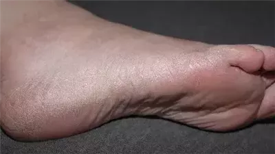 علامات لا تهملها إذا ظهرت على قدميك