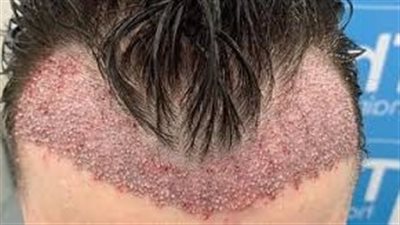 زراعة الشعر: استعادة كثافة الشعر وحل مشكلة الصلع