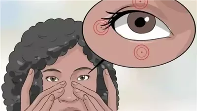 سبب  الإصابة بتشنجات العين