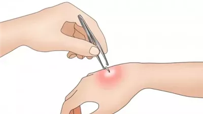 خطوات يجب تنفيذها في حالة التعرض للدغات النحل
