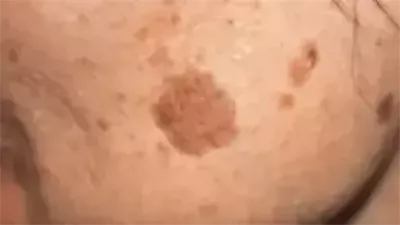 وصفة طبيعية للتخلص من النمش