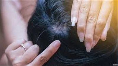 وداعاً للصلع: إليكِ طريقة تنبيت الشعر بشكلٍ طبيعيّ
