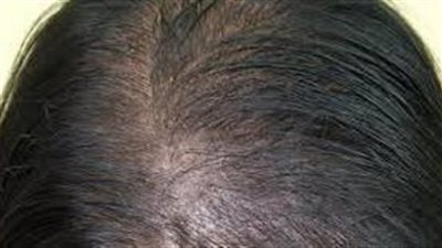 وداعاً للفراغات: إليكِ طرق إخفاء فراغات الشعر