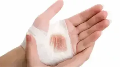 ما هي أنواع الچروح ؟