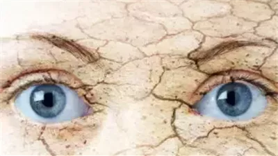 أسباب تؤدي إلى ظهور الإكزيما