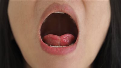 ما هي أسباب بلع اللسان وطرق التعامل معه ؟