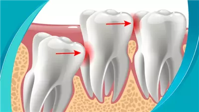 تهدئة آلام ضرس العقل بمكونات طبيعية