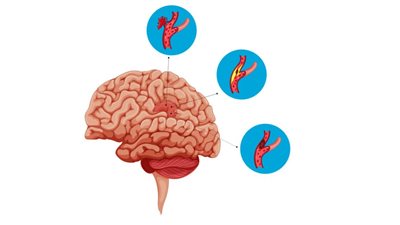 أعراض تشير إلى تمدد الأوعية في الدماغ