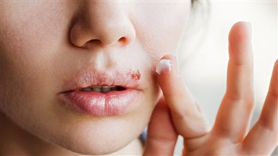 طُرُق طبيعية للتخلص من قرحة البرد