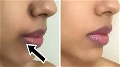 وداعاً لسواد حول الفم: حلول منزلية سريعة وفعّالة