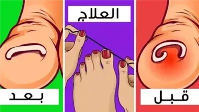 علاج أمراض الأظافر الشائعة بمكونات طبيعية