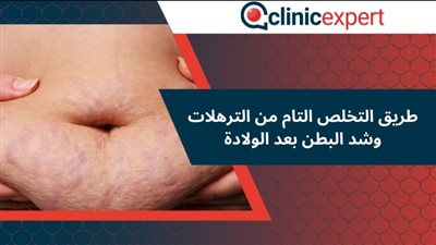 كيف نتخلص من ترهلات البطن بعد الولادة