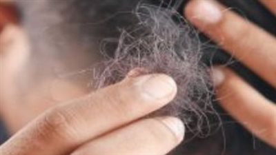 تعرف على  تفسير رؤية مرض الثعلبة في المنام