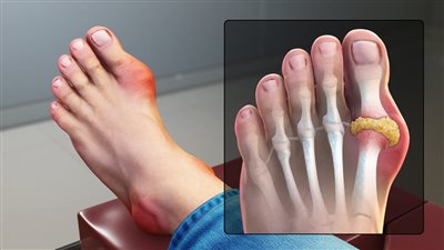 اطعمة آمنه لمرضى النقرس