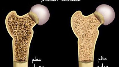 تماريح تزيد كثافة العظام
