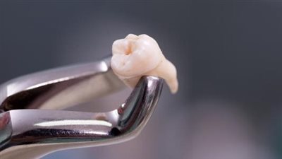 تعرف على تفسير خلع السن في المنام