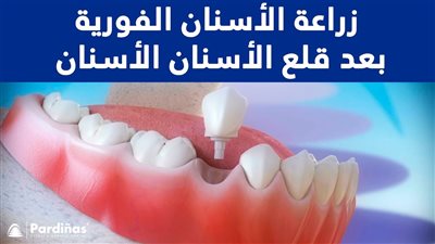 تكلفة زراعة السن الواحد في السعودية: إليك التفاصيل